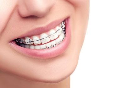 دانلود پرانتز درمان ارتودنسی. مفهوم مراقبت از دندان لبخند زن زیبا زنانه نزدیک است. سرامیک و فلزی نزدیک نزدیک