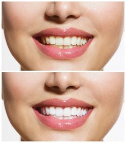 دانلود دندانهای زن قبل و بعد از سفید شدن. بیش از پس زمینه سفید. مبارک لبخند زن مفهوم سلامت دندان. بهداشت دهان