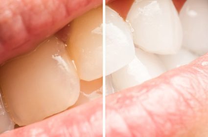 دانلود دندانهاي زن قبل و بعد از سفيد کردن روش در کلينيک دندانپزشکي
