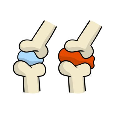 ناقل بیماری آرتریت مفاصل استخوان ها و بین استخوانی