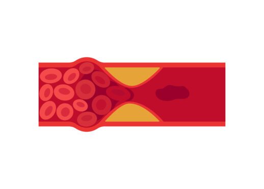 ناقل ترومبوز لخته خون در ترومبوز ورید عمقی ورید یا شریان