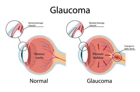 تصویر برداری که گلوکوم چشم را با زاویه باز نشان می دهد