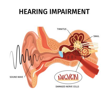 ترکیب آناتومیک ناقل اختلال شنوایی