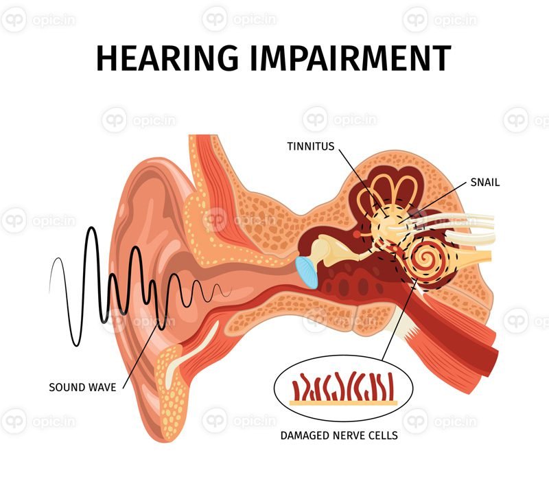 ترکیب آناتومیک ناقل اختلال شنوایی