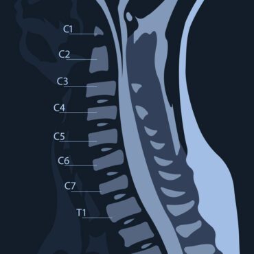 تصویر برداری رزونانس مغناطیسی یا MRI از ستون فقرات گردنی در