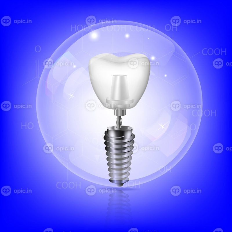 وکتور ایمپلنت دندان سفید واقع گرایانه در پس زمینه آبی در a