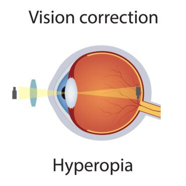 تصحیح بینایی برداری تصویر دوربینی بینایی