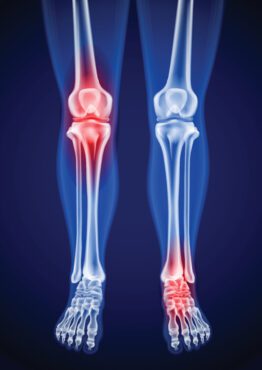 تصاویر وکتور اشعه ایکس از ران های انسان، زانو و پا درد را نشان می دهد